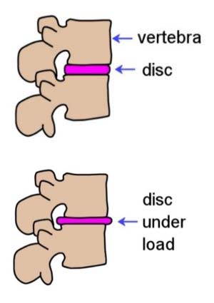 Spinal disc and disc under load